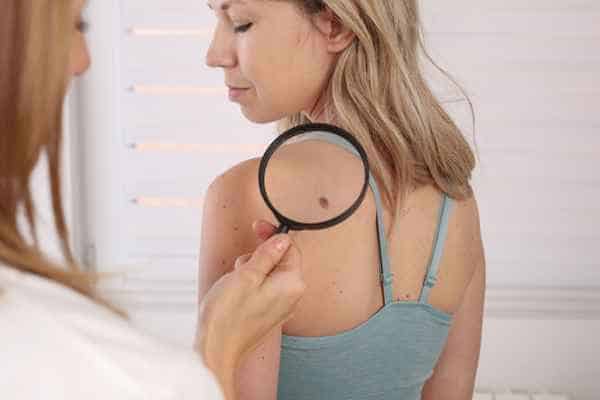 What Are Traditional Skin Lesion Removal Methods Southall?