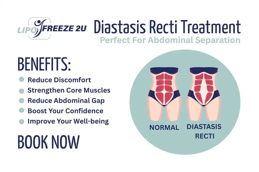 Benefits of body toning treatment Southall for Diastasis recti