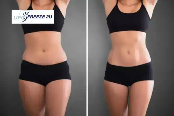 How Can LIPO FREEZE 2U Support Your Post-Pregnancy Body Recovery Southall?