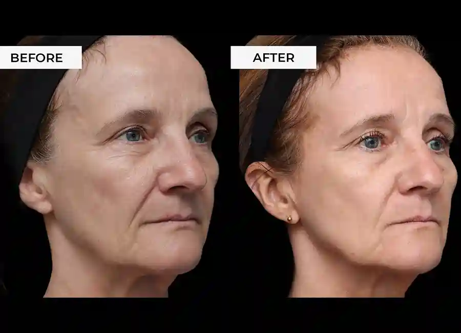 How Many RF Microneedling Sessions Will You Need to See a Difference Southall?