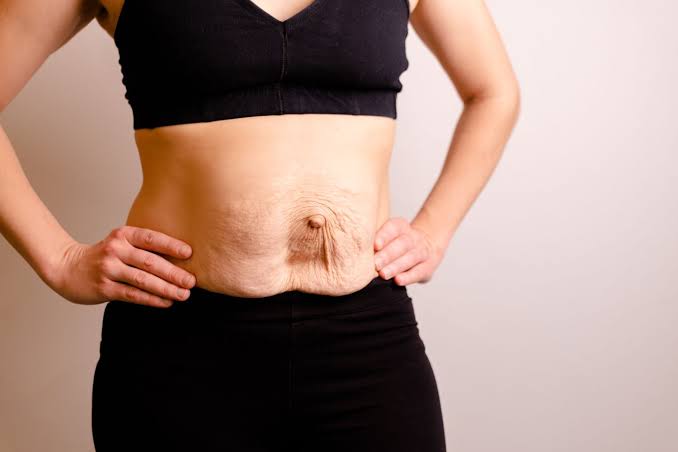 Is Surgery Really the Only Way to Repair Diastasis Recti Southall?