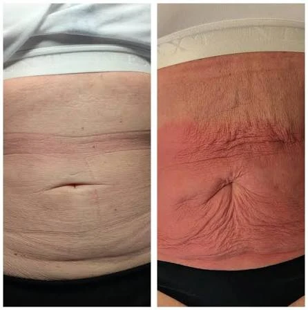 How Does RF Microneedling Improve Crepey, Thin and Uneven Skin Texture Southall?
