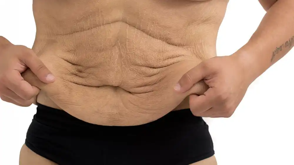 RF Microneedling for Loose Skin: How Can It Help Tighten and Reshape the Skin Southall?